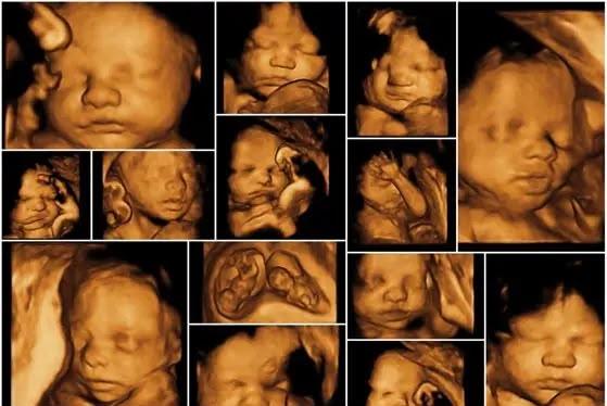 3D/4D/5D ULTRASOUND